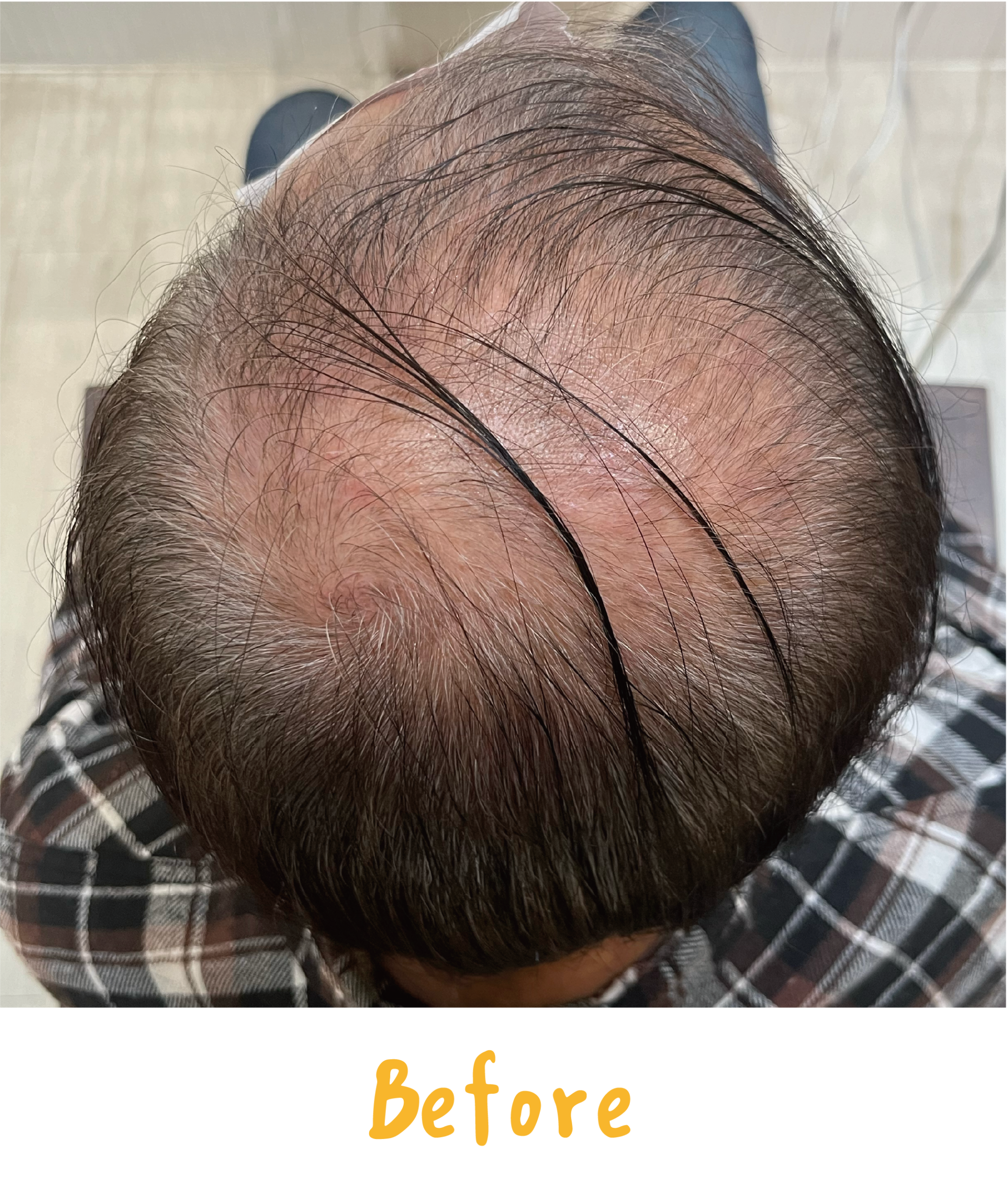 畝吉外泌體before after-01