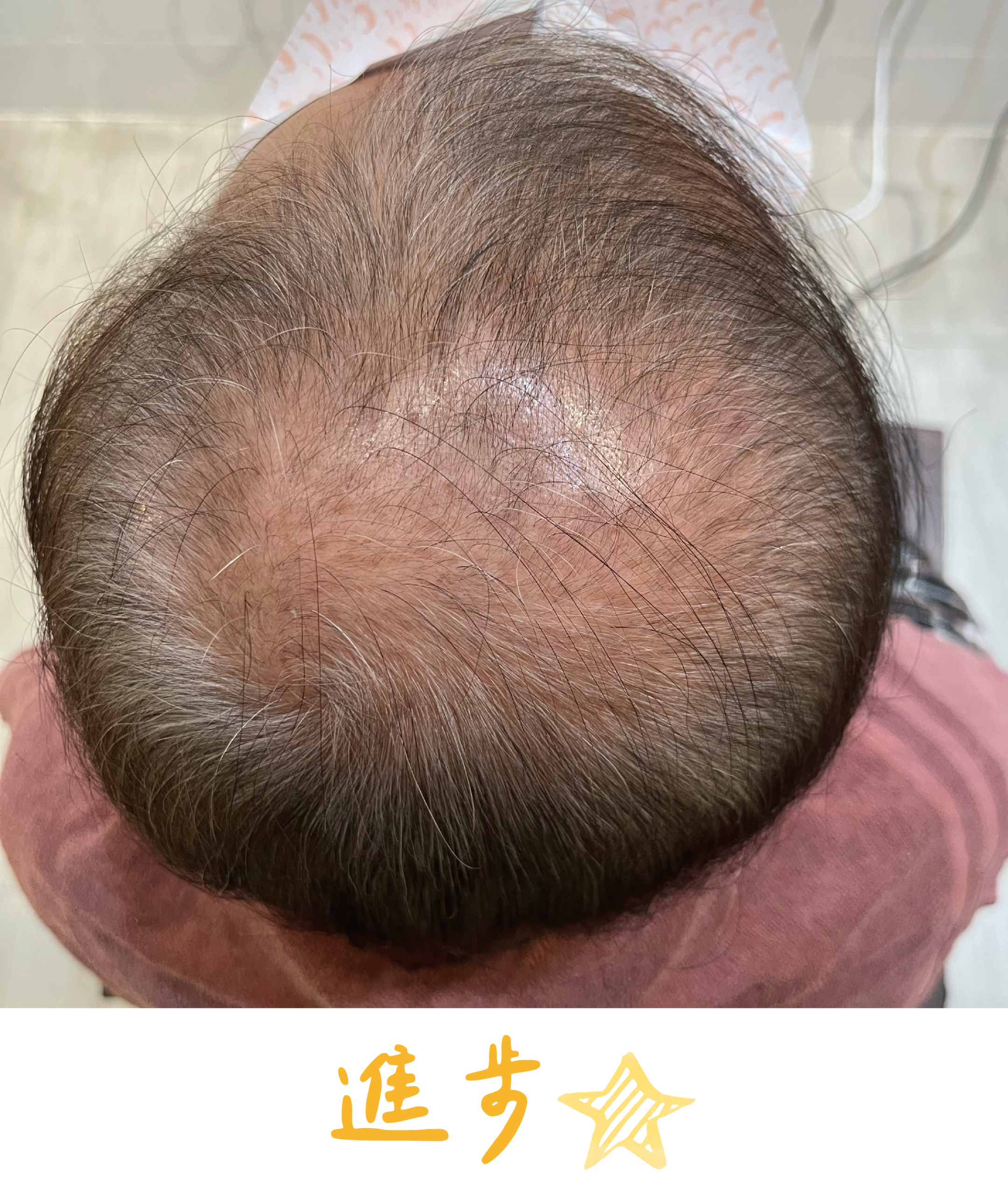 畝吉外泌體before after-02