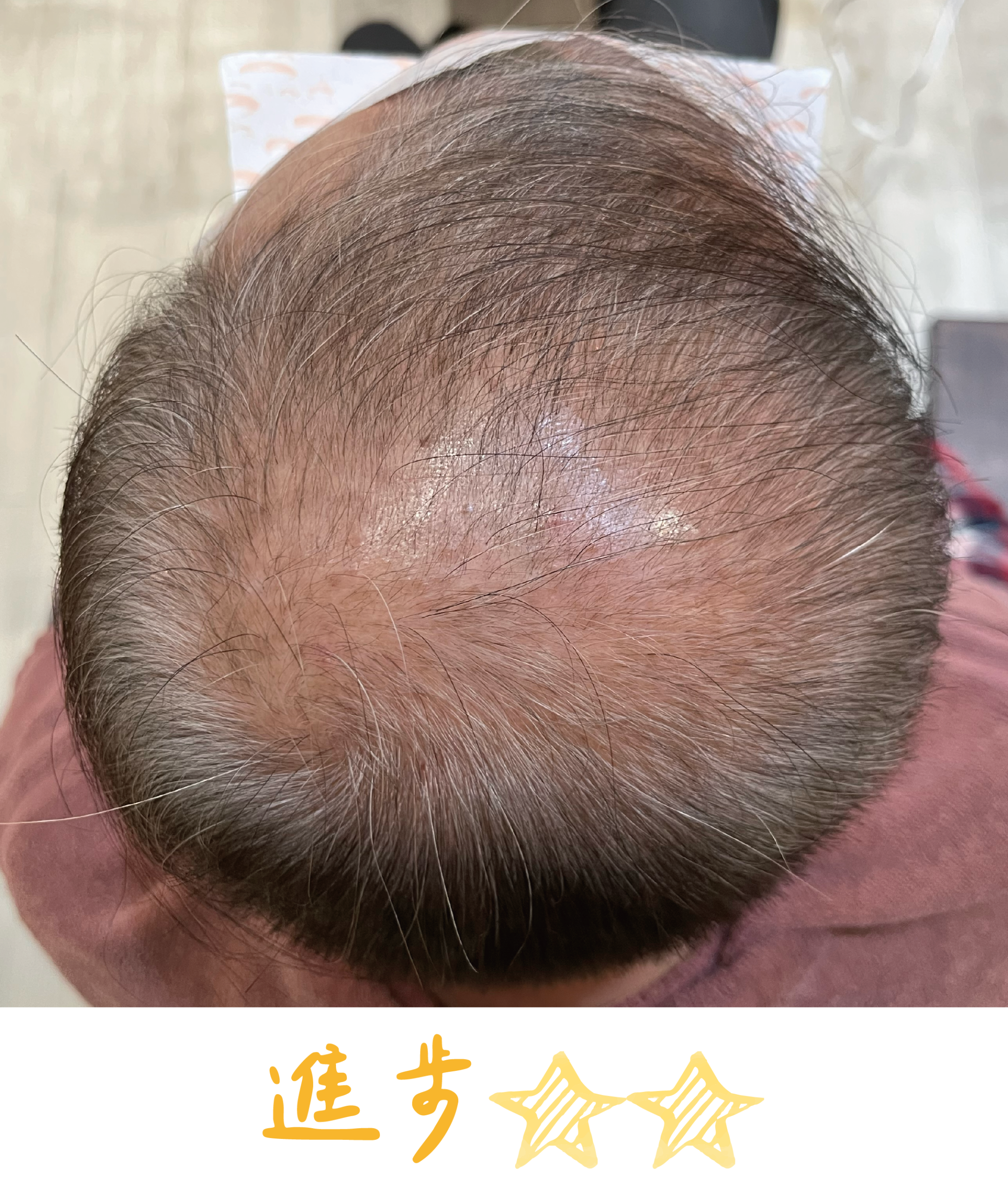 畝吉外泌體before after-03