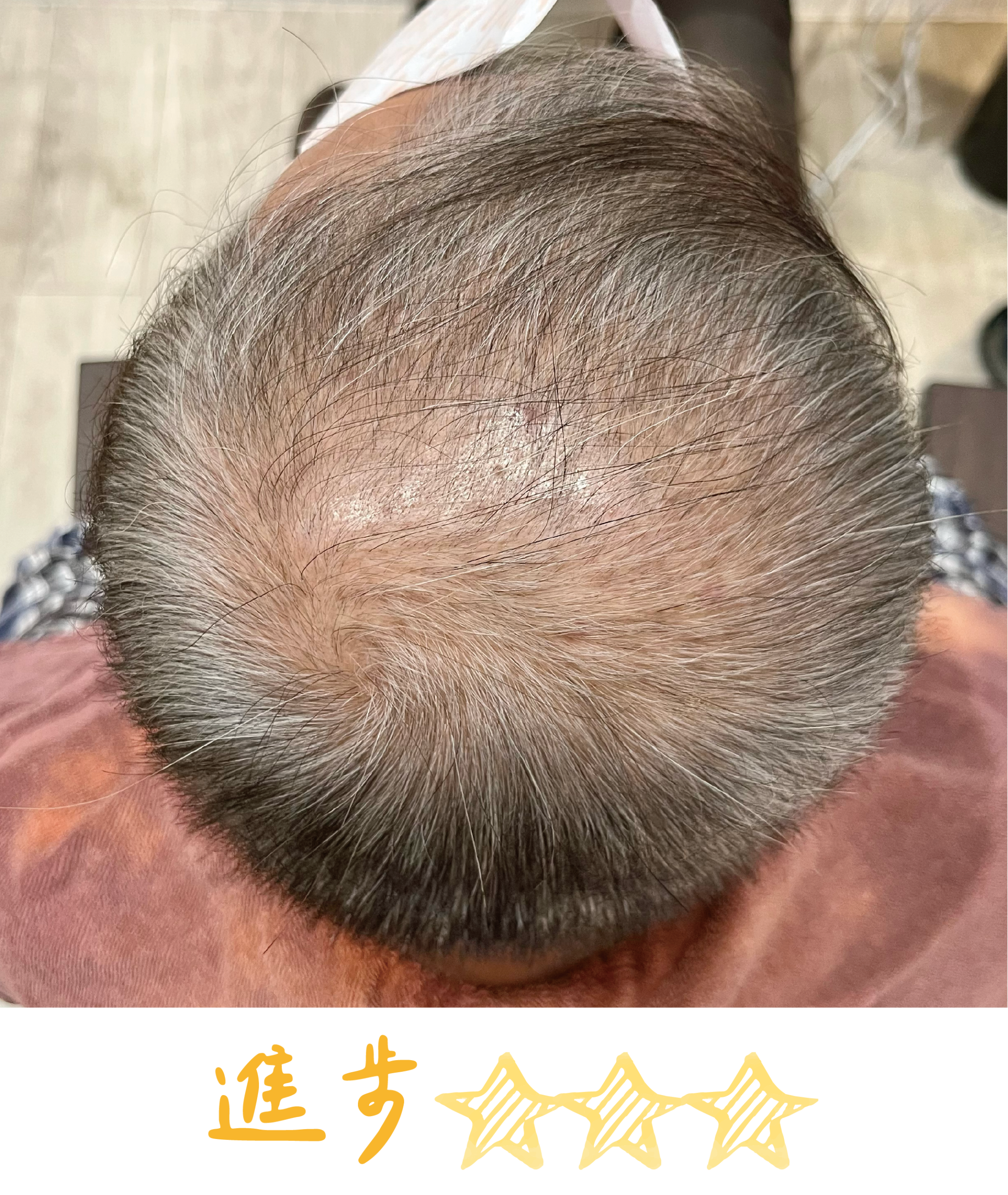 畝吉外泌體before after-04