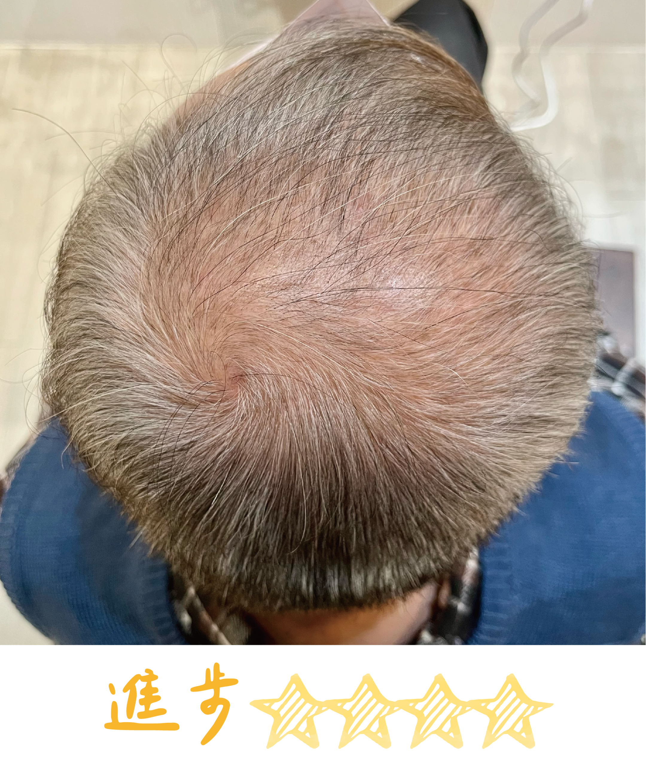 畝吉外泌體before after-05