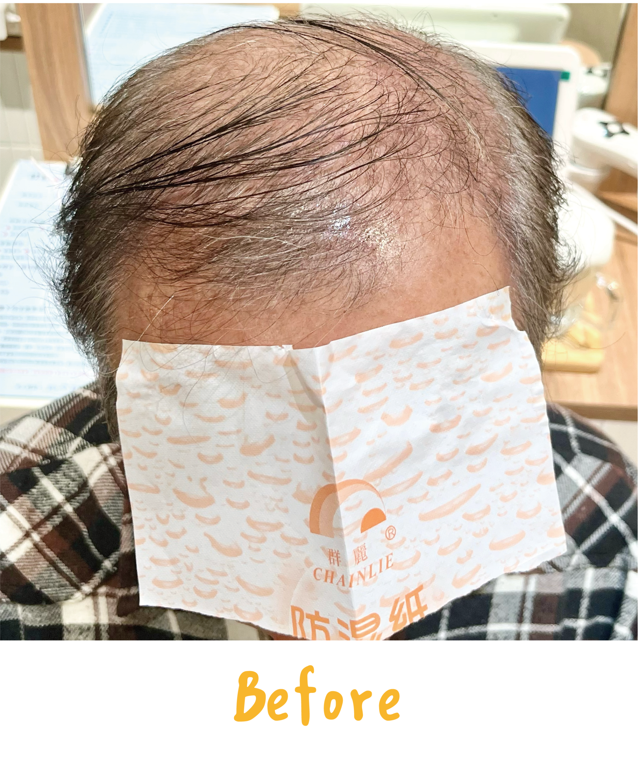 畝吉外泌體before after-06