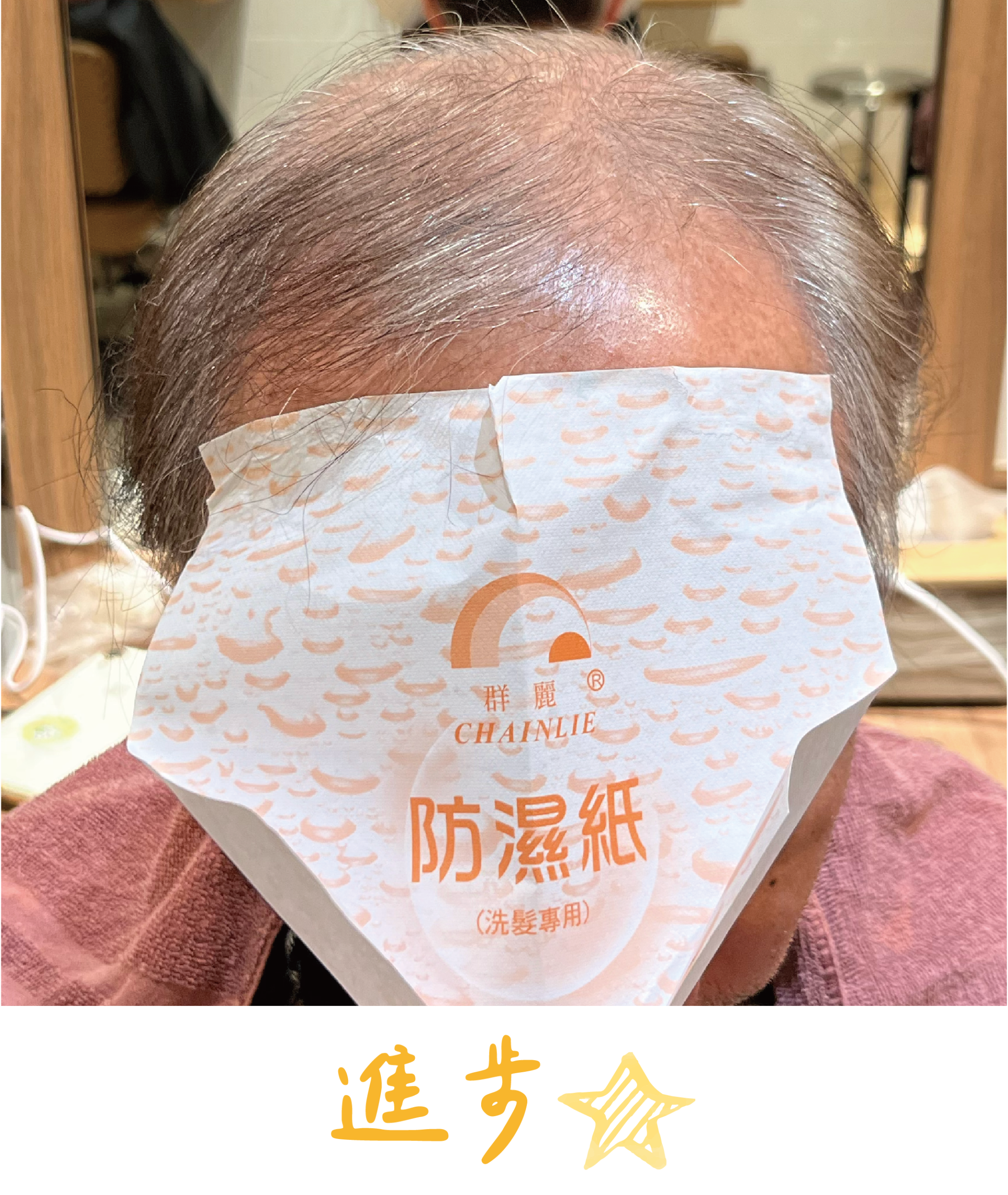 畝吉外泌體before after-07