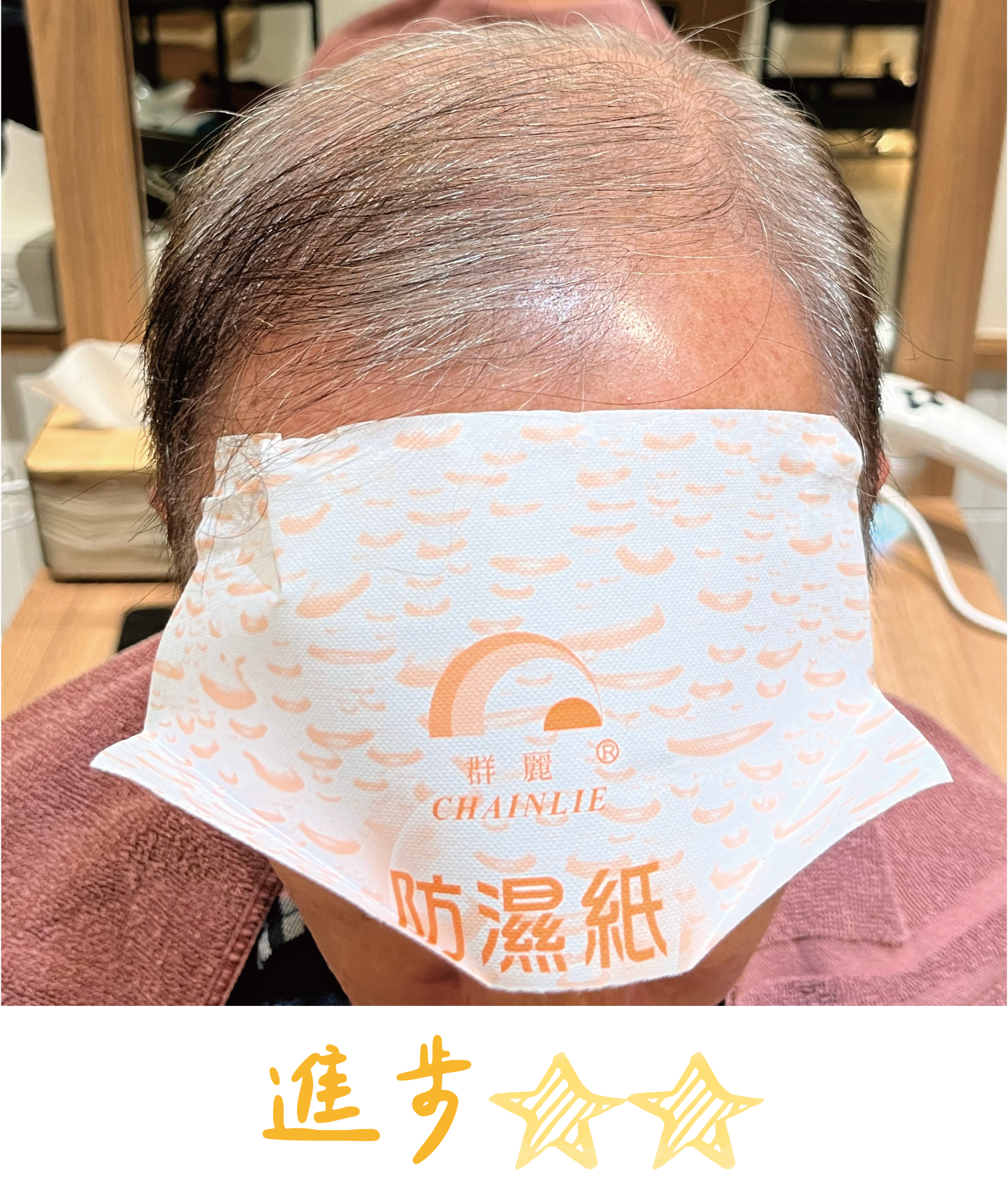 畝吉外泌體before after-08