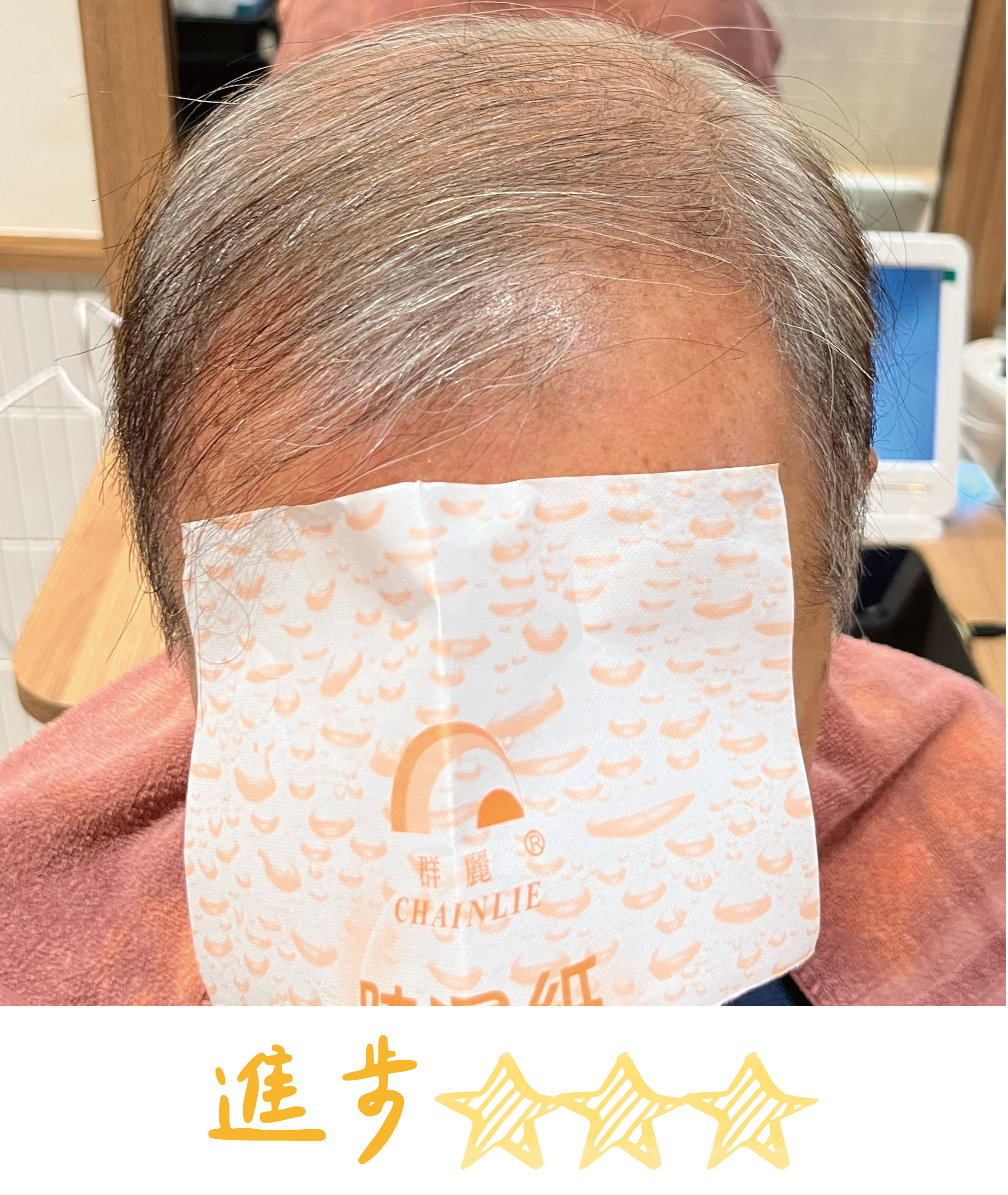 畝吉外泌體before after-09