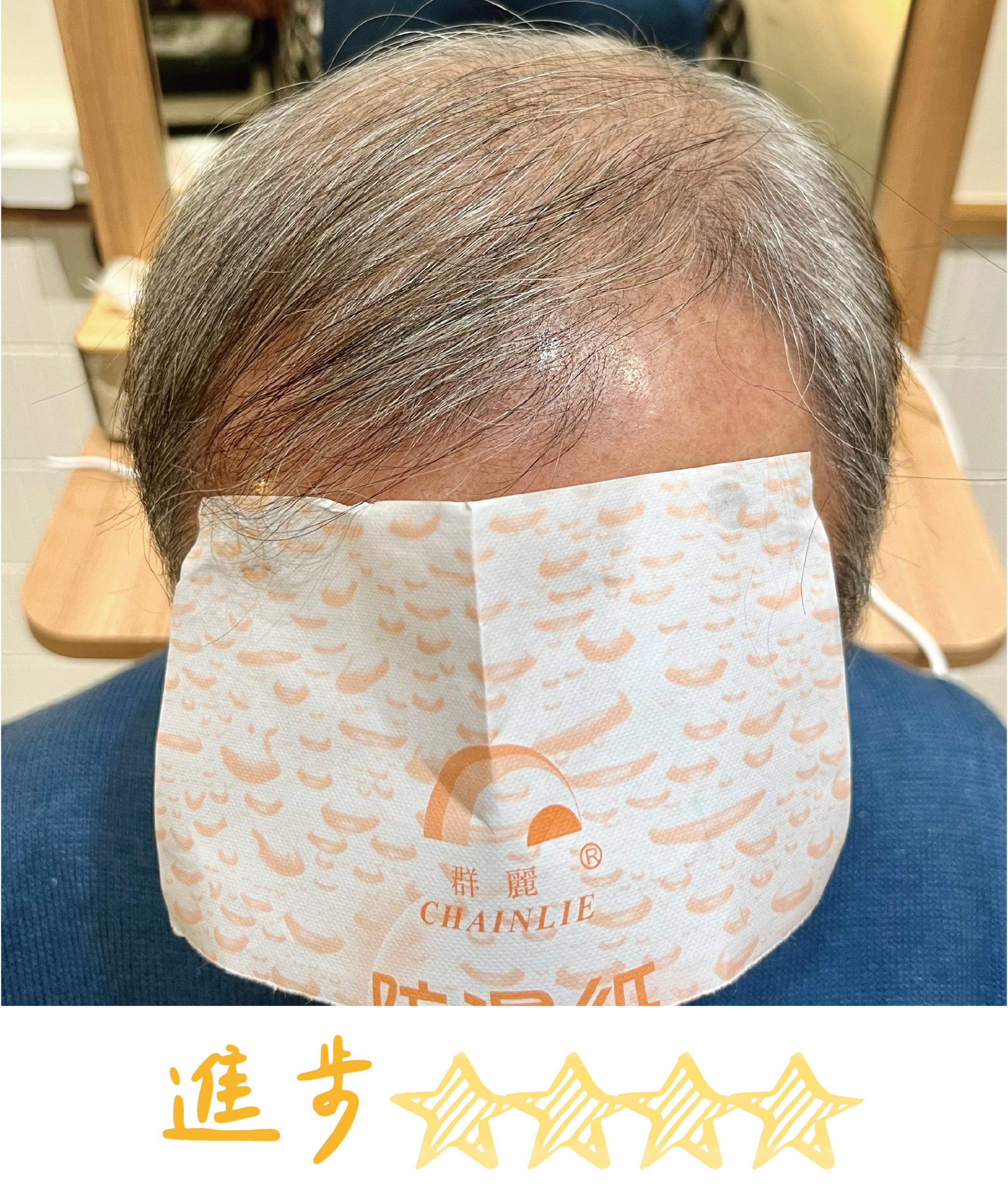 畝吉外泌體before after-10