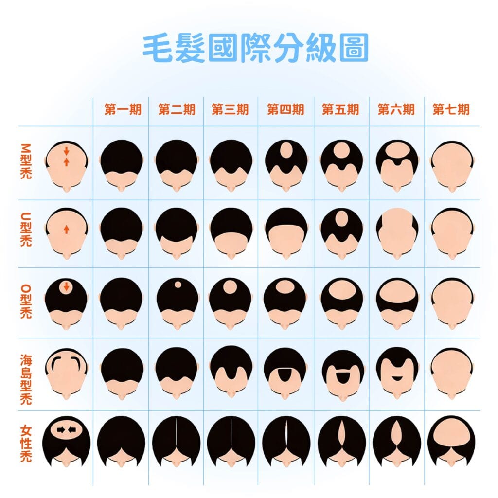 掉髮前兆 細毛與粗毛差異