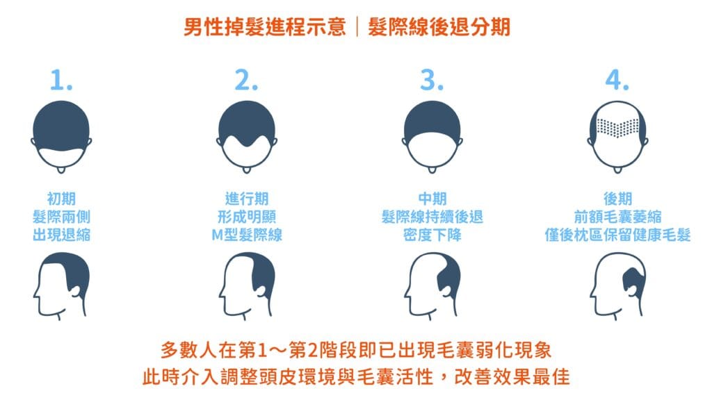 男性掉髮分期圖|髮際線後退4階段(M型禿),說明頭頂變稀與毛囊萎縮過程,天母士林北投掉髮改善參考