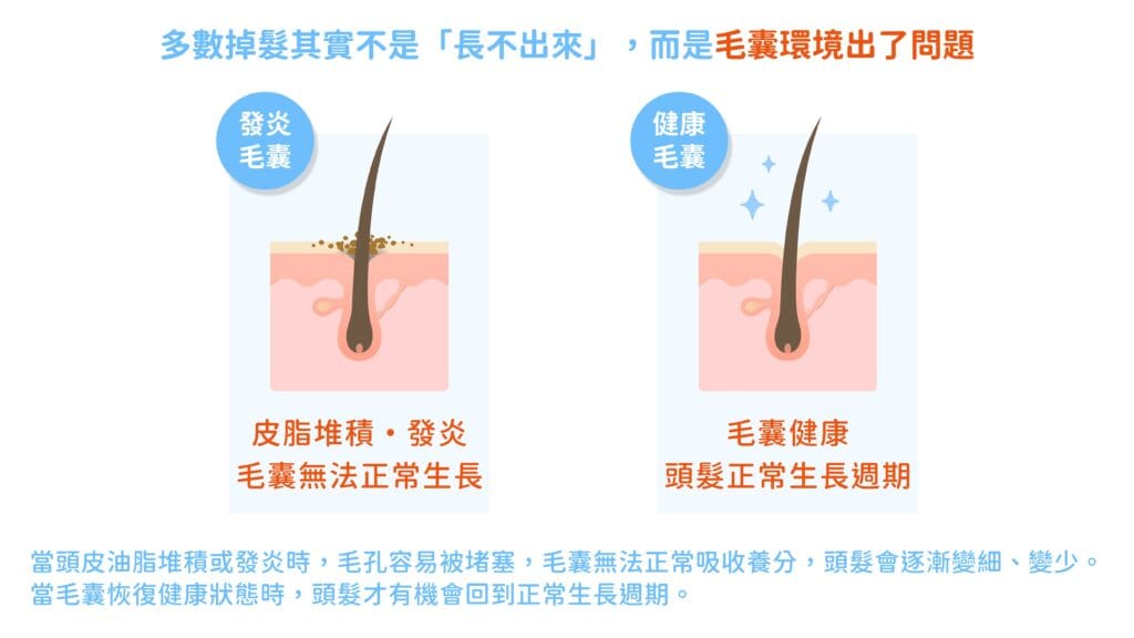 頭皮毛囊堵塞與健康毛囊對比圖,說明頭髮變稀原因包含皮脂堆積與毛囊功能下降,影響頭髮生長密度