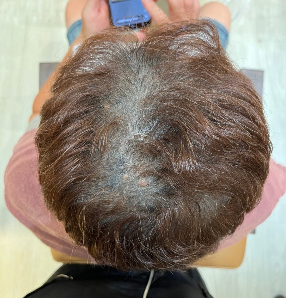 外泌體生髮前頭頂透光狀況