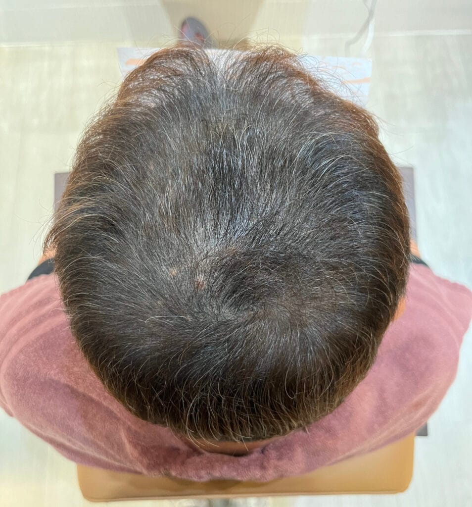 外泌體生髮2個月頭頂變化