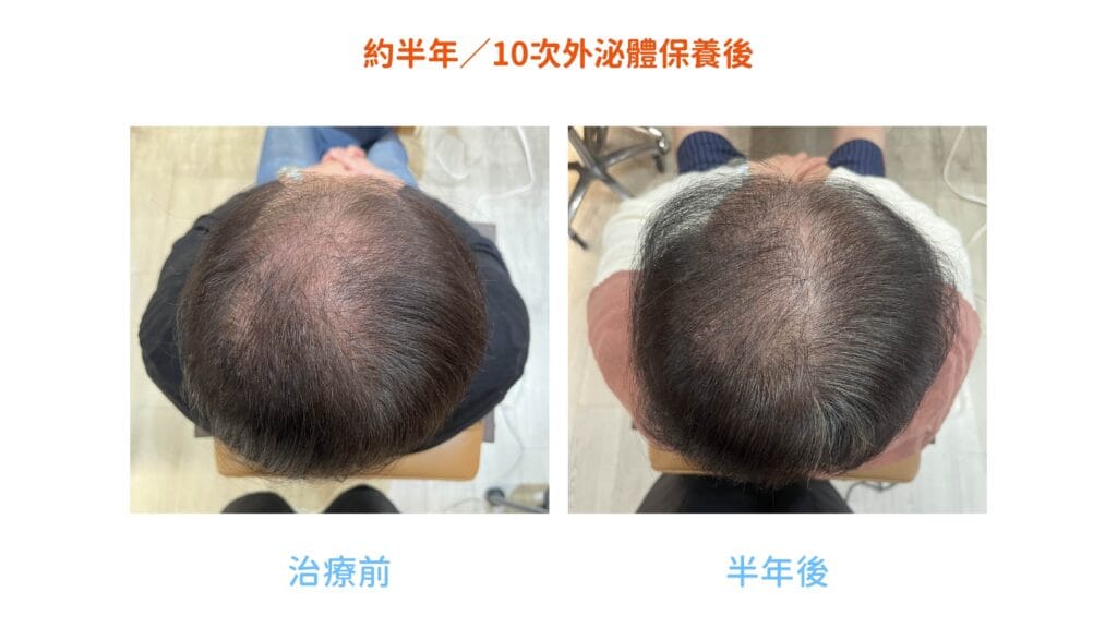 天母外泌體生髮半年案例前後對比