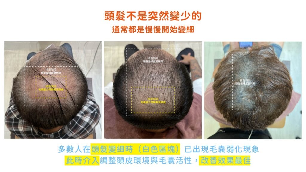 男性頭頂稀疏與掉髮問題