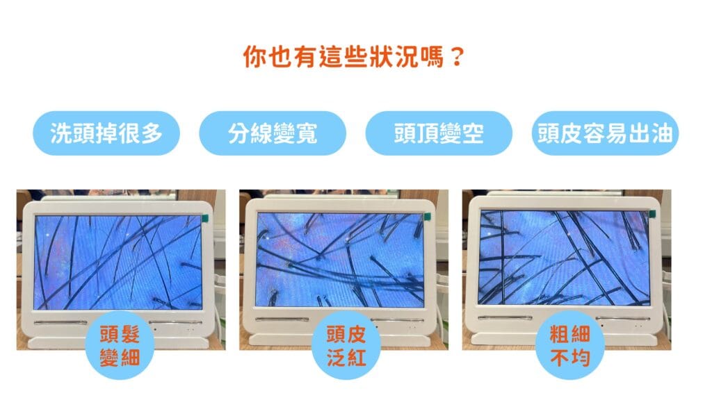 分線變寬與頭頂掉髮問題