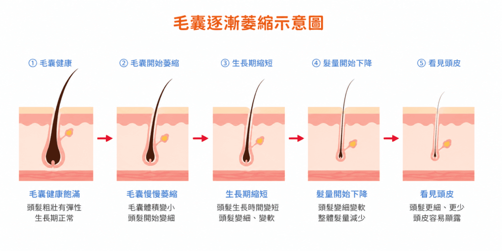 毛囊萎縮造成頭髮變細示意圖