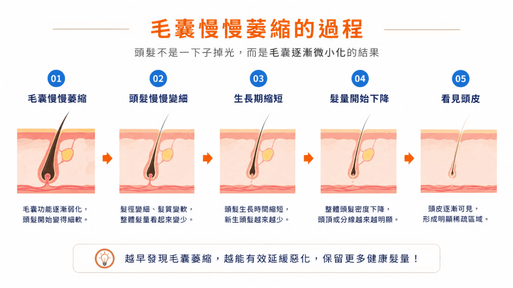 毛囊微小化過程示意圖|頭髮變細與頭頂變稀原因