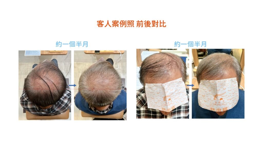 外泌體健髮案例改善頭頂稀疏狀況