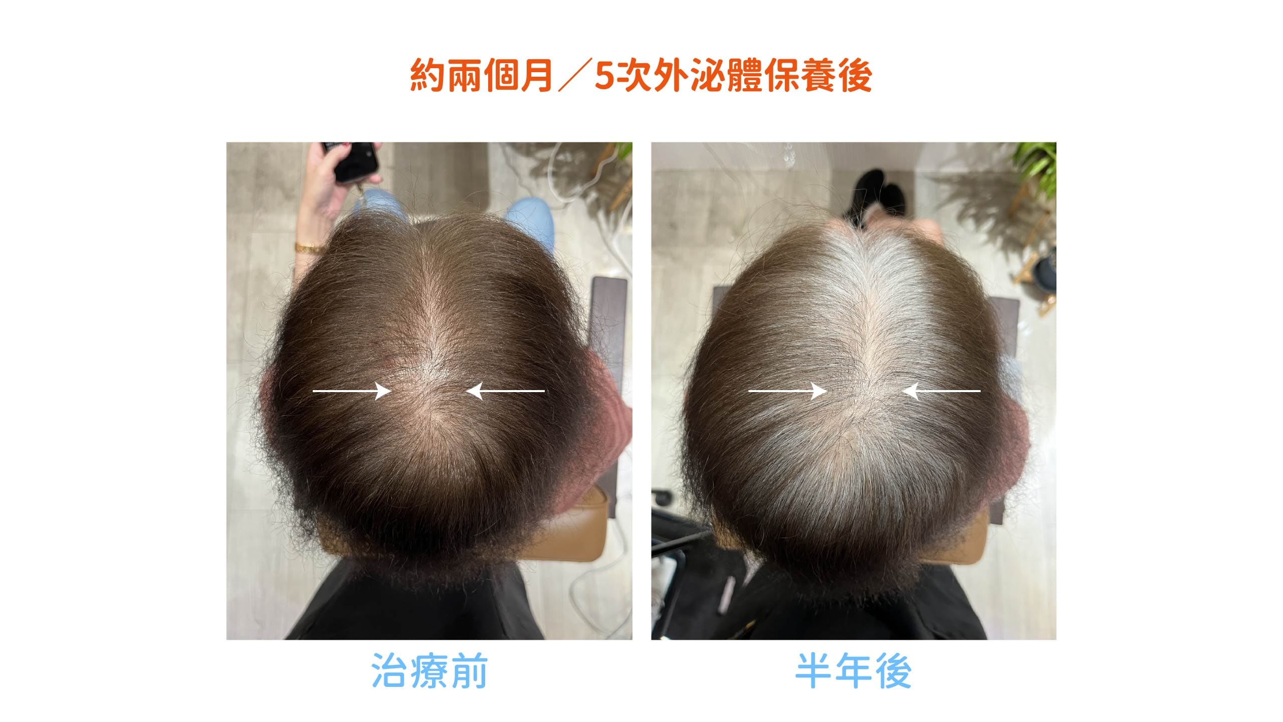 女生掉髮改善案例|頭頂髮量前後對比 女生掉髮改善案例,約兩個月完成5次外泌體毛囊修復保養後,頭頂透光範圍縮小、分線改善、髮量視覺密度提升。