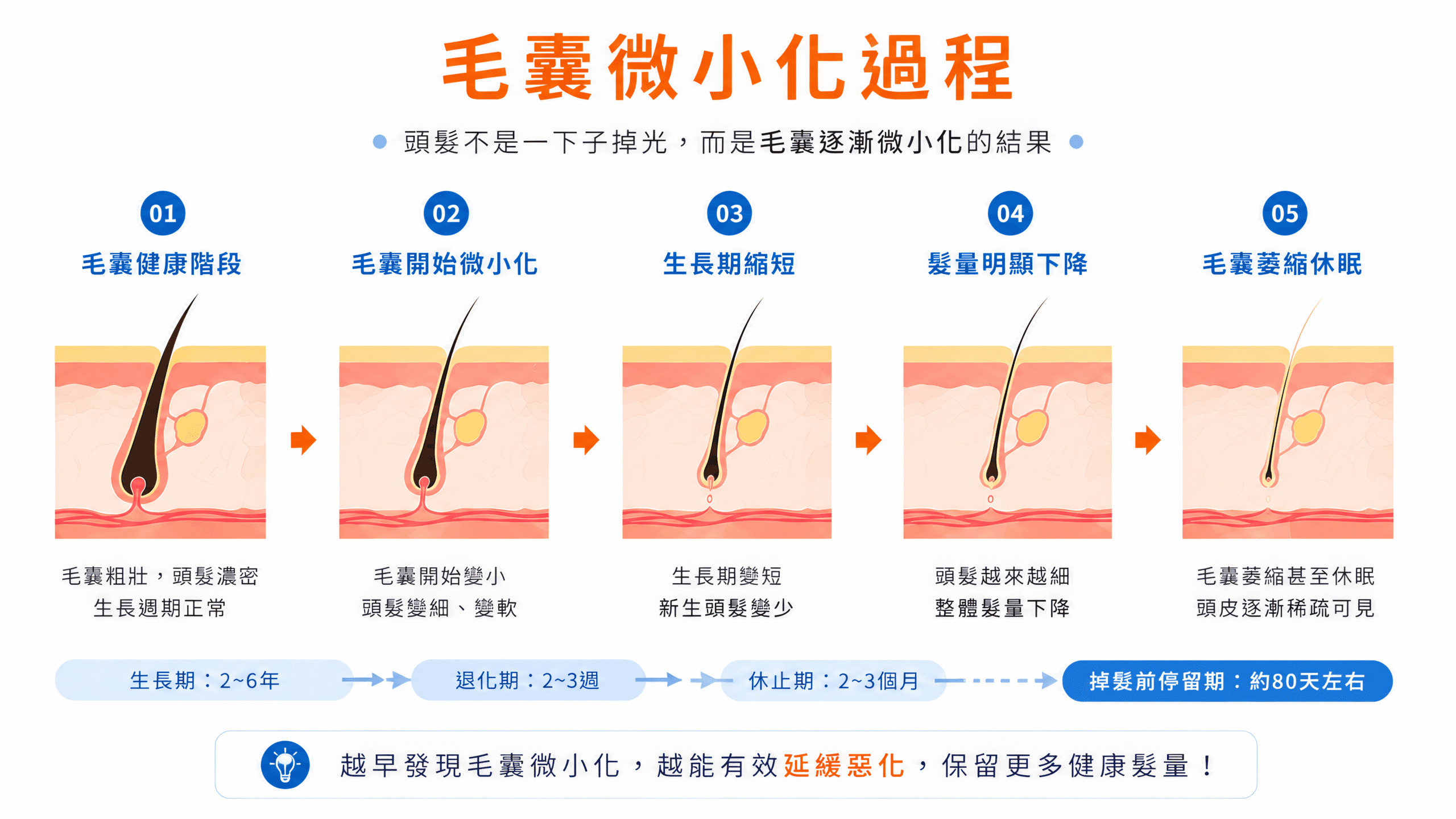 毛囊微小化過程 毛囊微小化過程示意圖,說明毛囊從健康到萎縮、頭髮逐漸變細與髮量下降的變化。