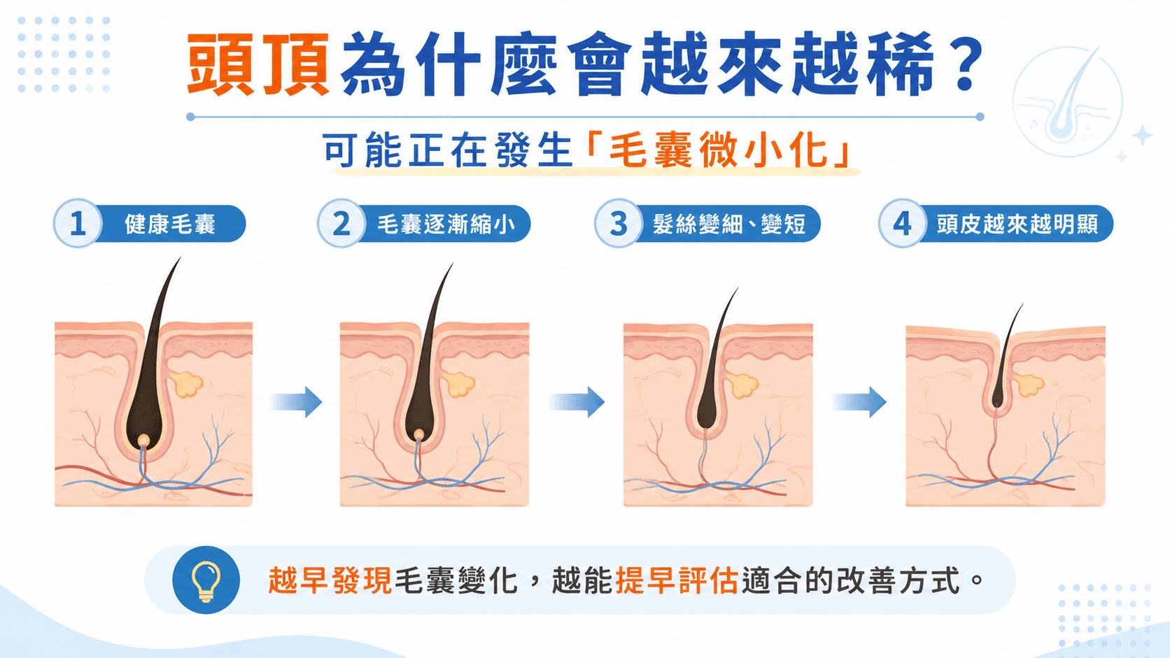 士林掉髮|毛囊微小化過程 士林掉髮毛囊微小化與頭髮變細示意圖