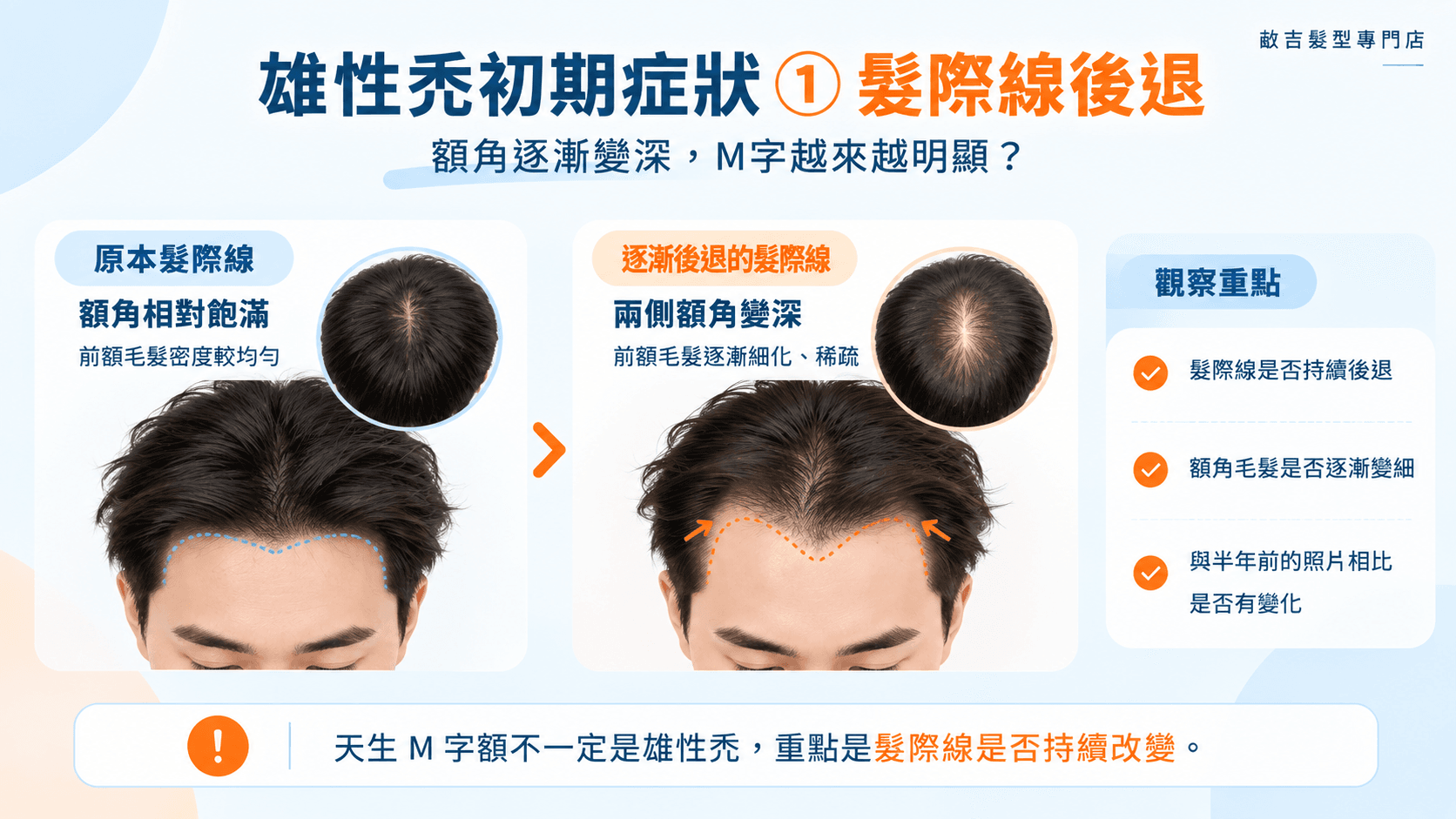 雄性禿初期症狀中的M字髮際線變化，對比正常髮際線與兩側額角逐漸後退、毛髮變稀的情況。
