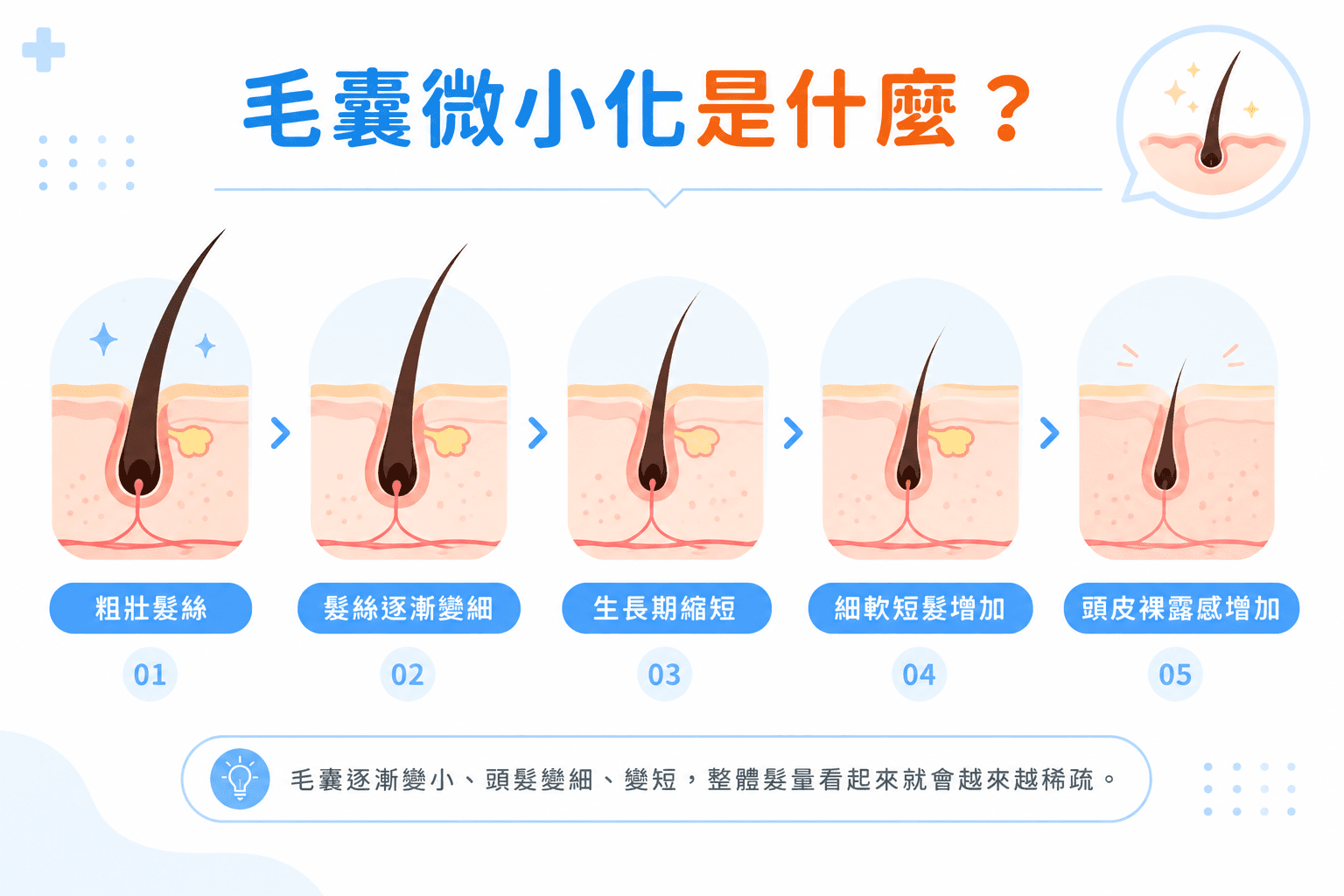 毛囊微小化過程，髮絲逐漸變細、生長期縮短與頭皮裸露感增加
