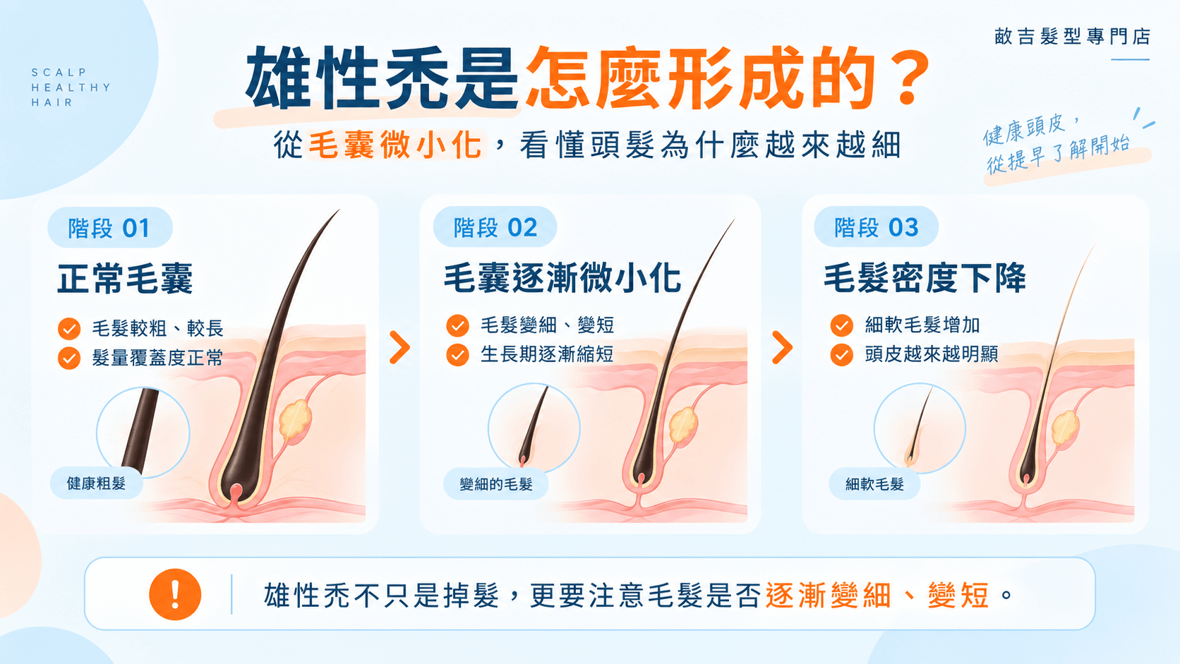 雄性禿初期症狀與毛囊微小化流程圖，呈現正常毛囊逐漸變小、頭髮變細及毛髮密度下降的過程。